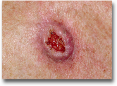 Squamous cell carcinoma detection treatment mohs surgery miami