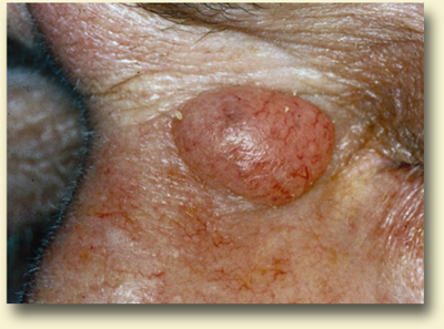 Basal cell carcinoma  treatment detection miami